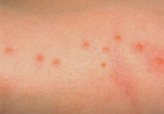 bed bug bites bed bugs bites will appear on areas of the body that are ...