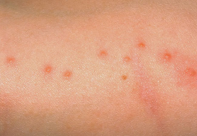 bed bug bites. Bed Bug Bites